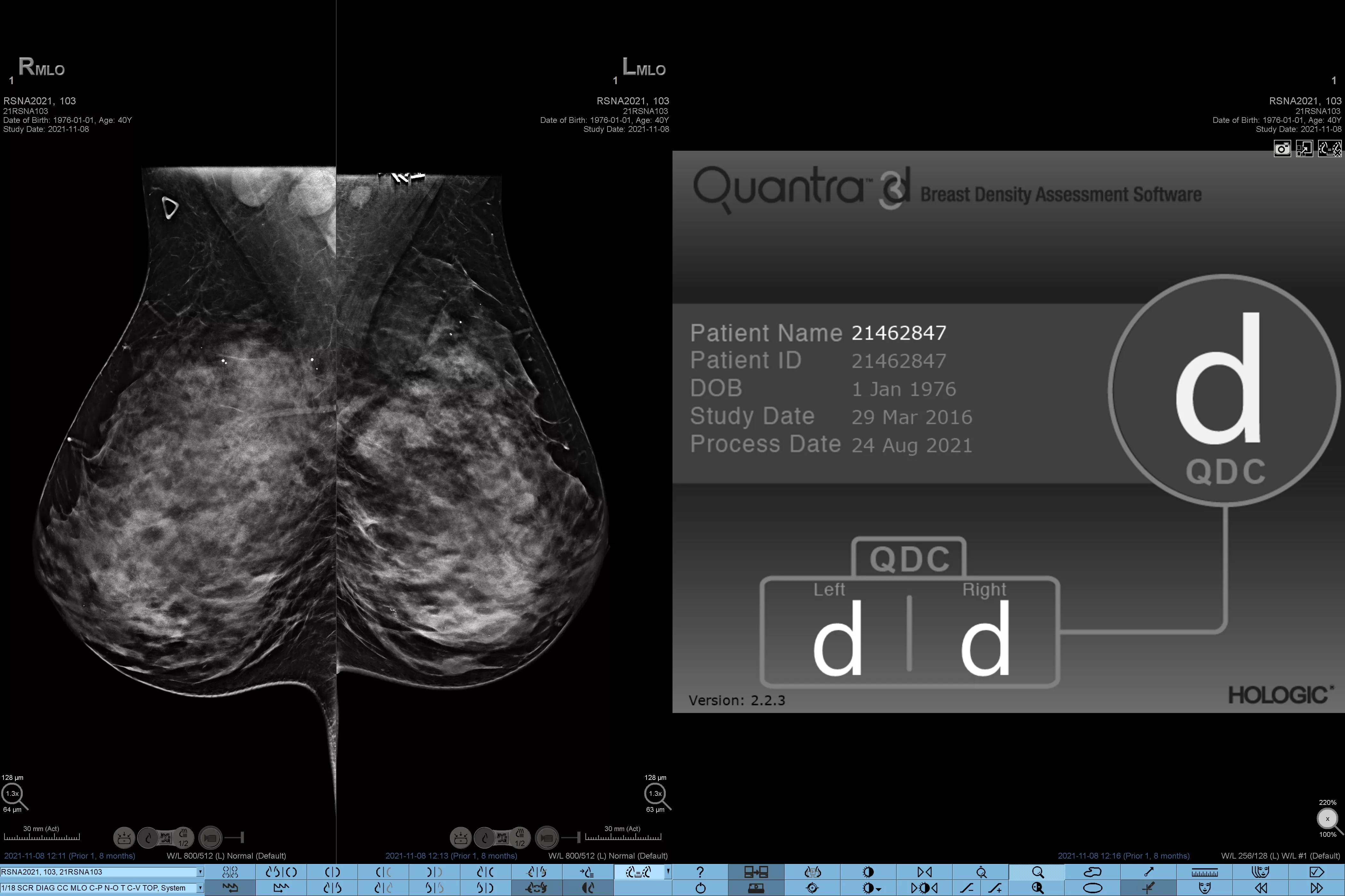 Diagnostic Breast Imaging 第2版 Diagnostic Imaging: Breast: 9781931884730: Medicine & Health